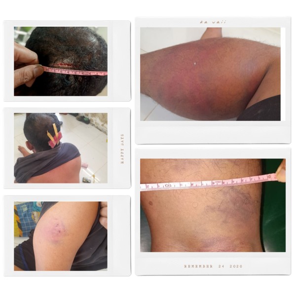 Tanpa Barang Bukti, Anasrul Dikeroyok Serta Dianiaya oleh Security dan Centeng PT. Tasma Puja