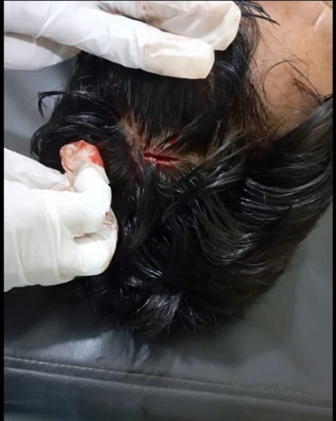 Oknum Security PTPN IV Kebun Tandun Aniaya Seorang Pria Hingga Alami Luka di Kepala